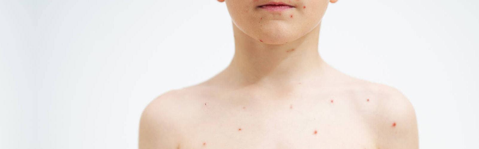 Chickenpox Vaccine in Woodhouse, Loughborough, Quorn, Mountsorrel, Coalville & Barrow upon Soar