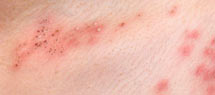 Shingles