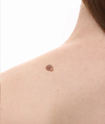 HPV Vaccine