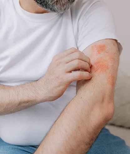 Shingles Vaccine