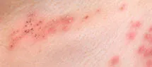 Shingles treatment in Loughborough, Quorn, Mountsorrel, Coalville, Barrow upon Soar, and Woodhouse