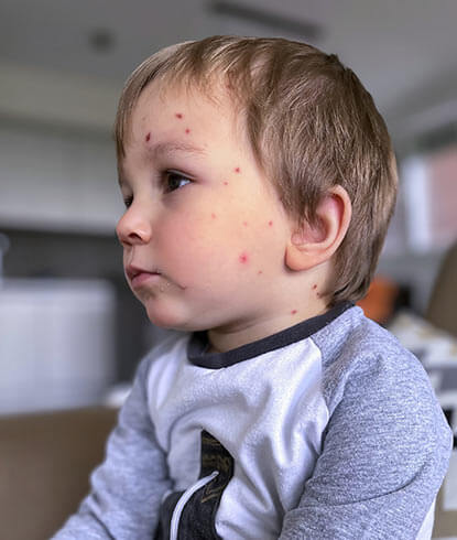 chickenpox